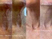 Neck before & 18 weeks healed